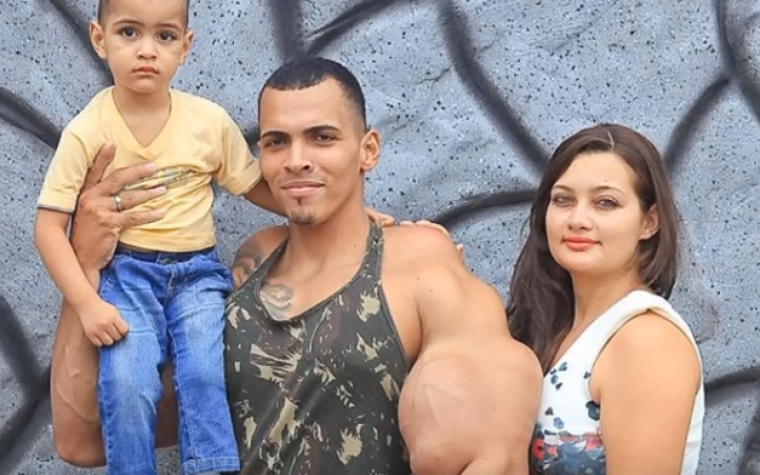 El Hulk brasileño que abusó del Synthol